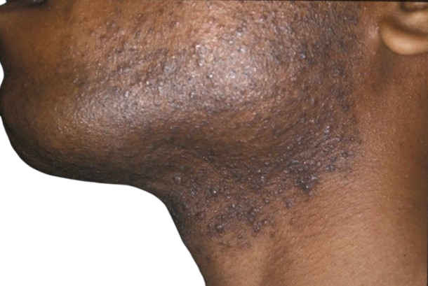 Razor Bumps